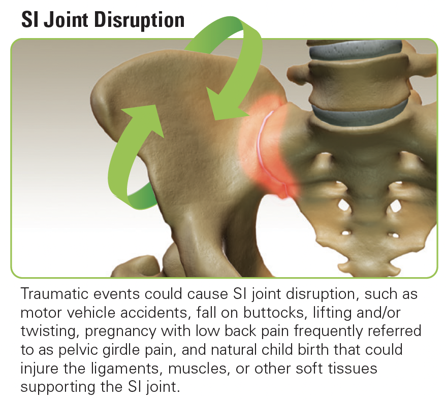 SI Joint Treatment San Juan Regional Medical Center